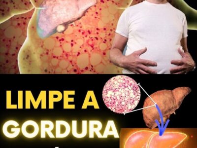 COMO LIMPAR A GORDURA NO FÍGADO: os 5 MELHORES ALIMENTOS PARA REVERTER A ESTEATOSE